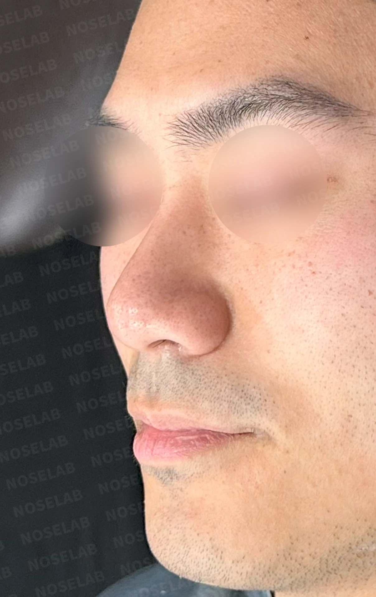 복코에 비공 비대칭과 코막힘이 함께 오는 이유, 직반 라인 교정은 어떻게 하나 — 수술 전 / 수술 직후 0일 직후 사진은 부기가 있는 상태로 최종 결과와 다를 수 있습니다.