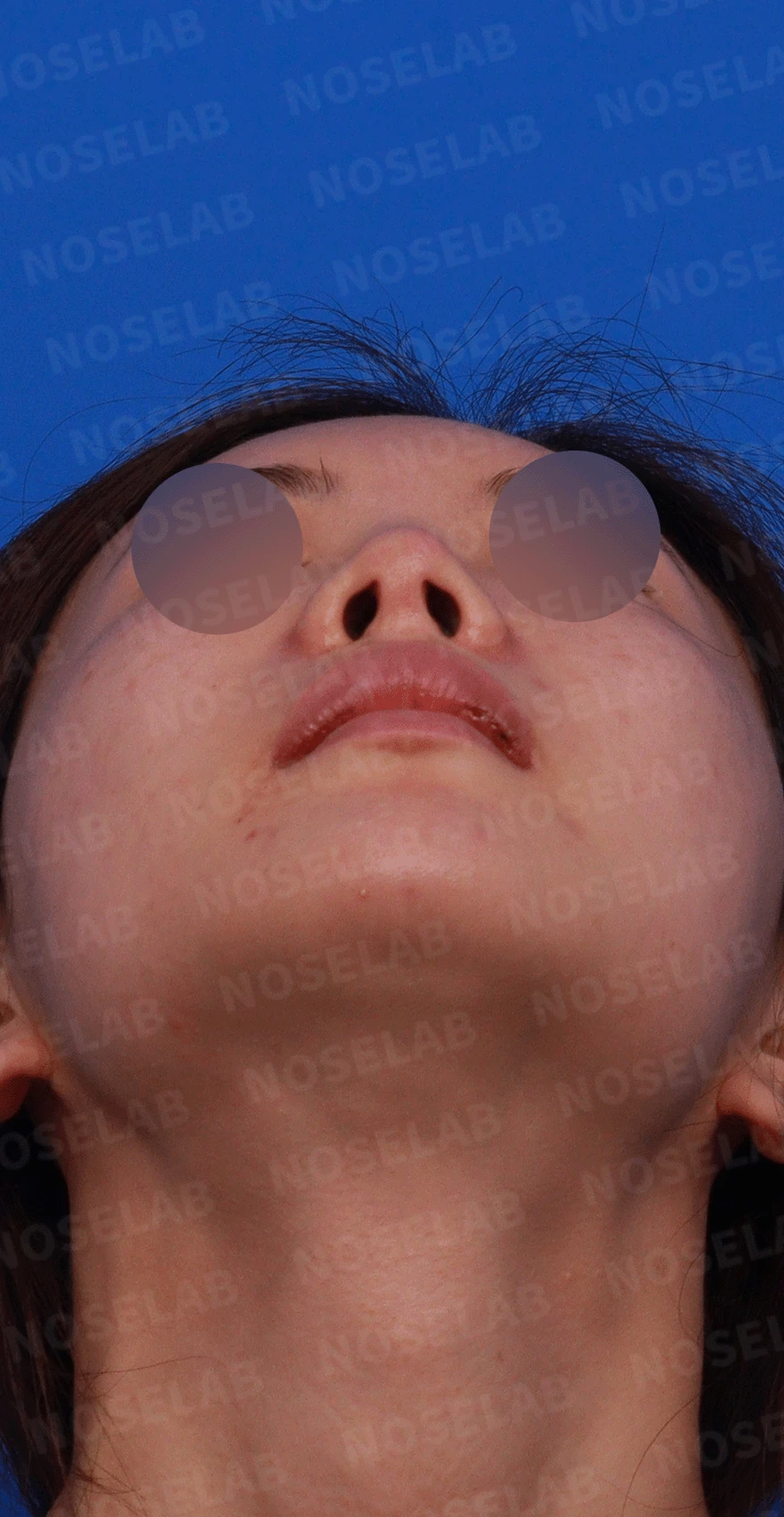 이전 수술로도 달라지지 않는 뭉툭한 코끝, 원인과 재건 방법 — 디자인 상담 우측 측면 , 비스듬한 측면 , 비공 사진입니다.
