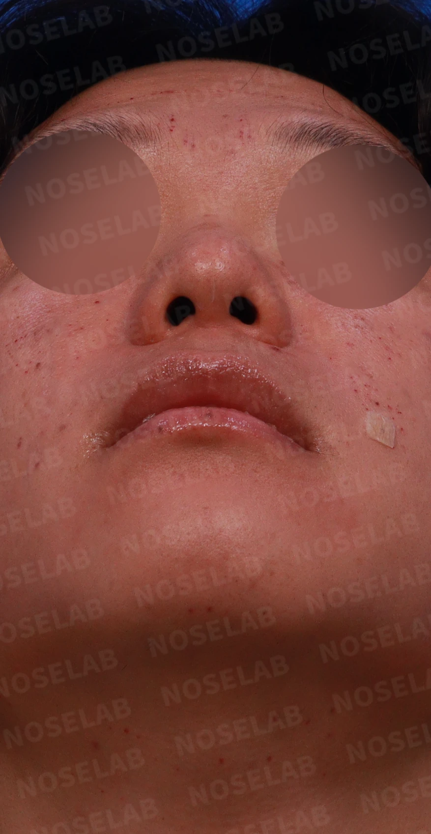 얼굴 비율을 고려한 코성형과 무턱 교정 방법 — 디자인 상담 우측 측면, 비스듬한 측면, 비공 사진입니다.
