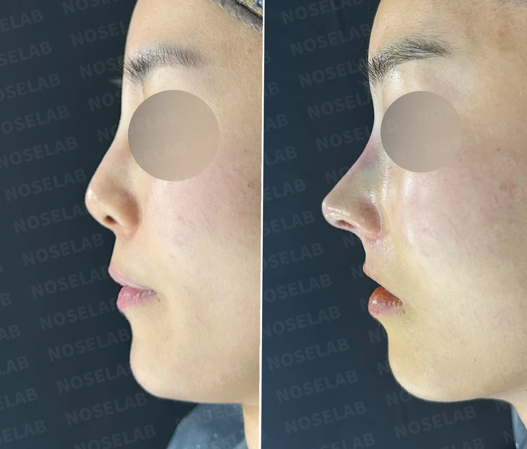 여러 차례 받은 코필러가 남긴 퍼진 코와 코막힘, 어떻게 정리하나 — 전후 비교
