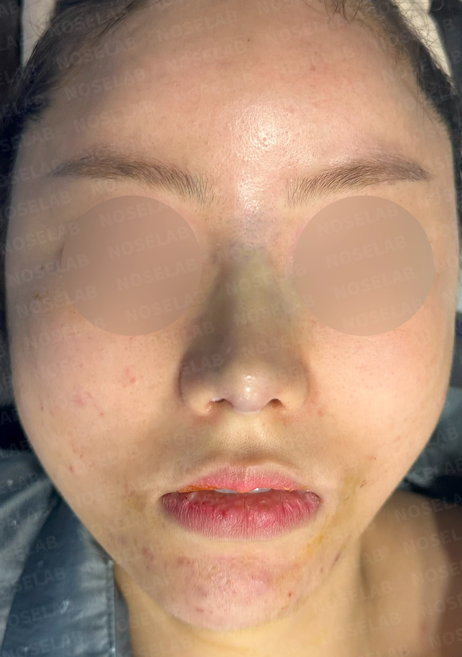 녹지 않고 남은 코 필러와 넓은 콧날개, 원인과 제거·교정 방법 — 수술 전 / 수술 직후 0일 직후 사진은 부기가 있는 상태로 최종 결과와 다를 수 있습니다.
