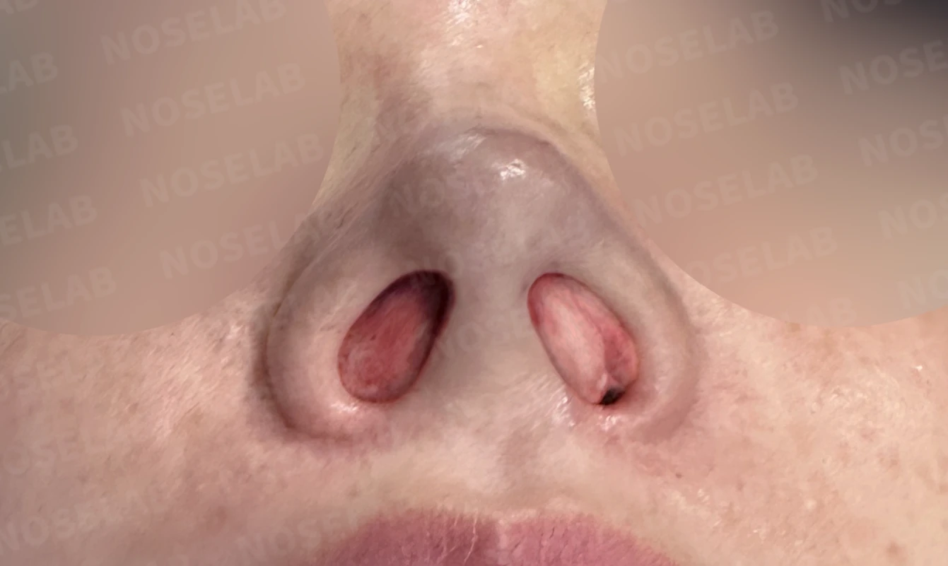 뭉툭하고 길게 처진 코가 중안면부를 길어 보이게 하는 이유, 석회화된 늑연골 재건 방법 — 수술 직후 0일 비공 사진입니다. 직후 사진은 부기가 있는 상태로 최종 결과와 다를 수 있습니다.