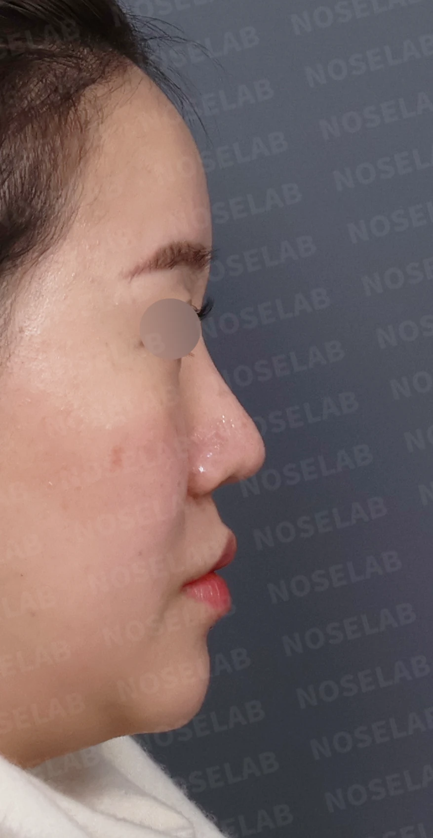 비주 함몰과 콧날개 변형, 자가늑연골을 이용한 코재수술로 자연스럽게 교정 — 디자인 상담 우측 측면, 비스듬한 측면, 비공 사진입니다.