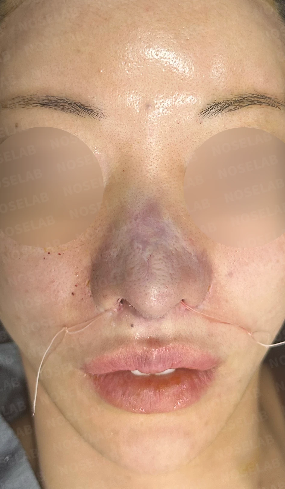 코 수술 뒤 콧등 피부가 괴사하면 어떤 변화가 남고, 재건은 어떻게 하나 — 수술 전 / 수술 직후 0일 직후 사진은 부기가 있는 상태로 최종 결과와 다를 수 있습니다.