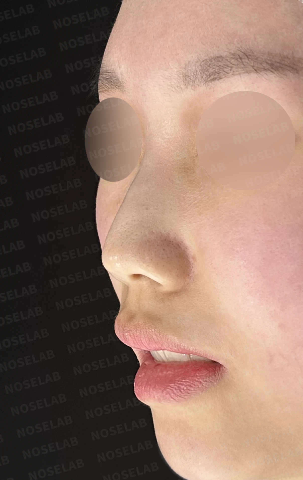 무보형물 코성형, 휘어진 콧대와 처진 코끝을 자연스럽게 교정 — 전(좌) 직후(후)