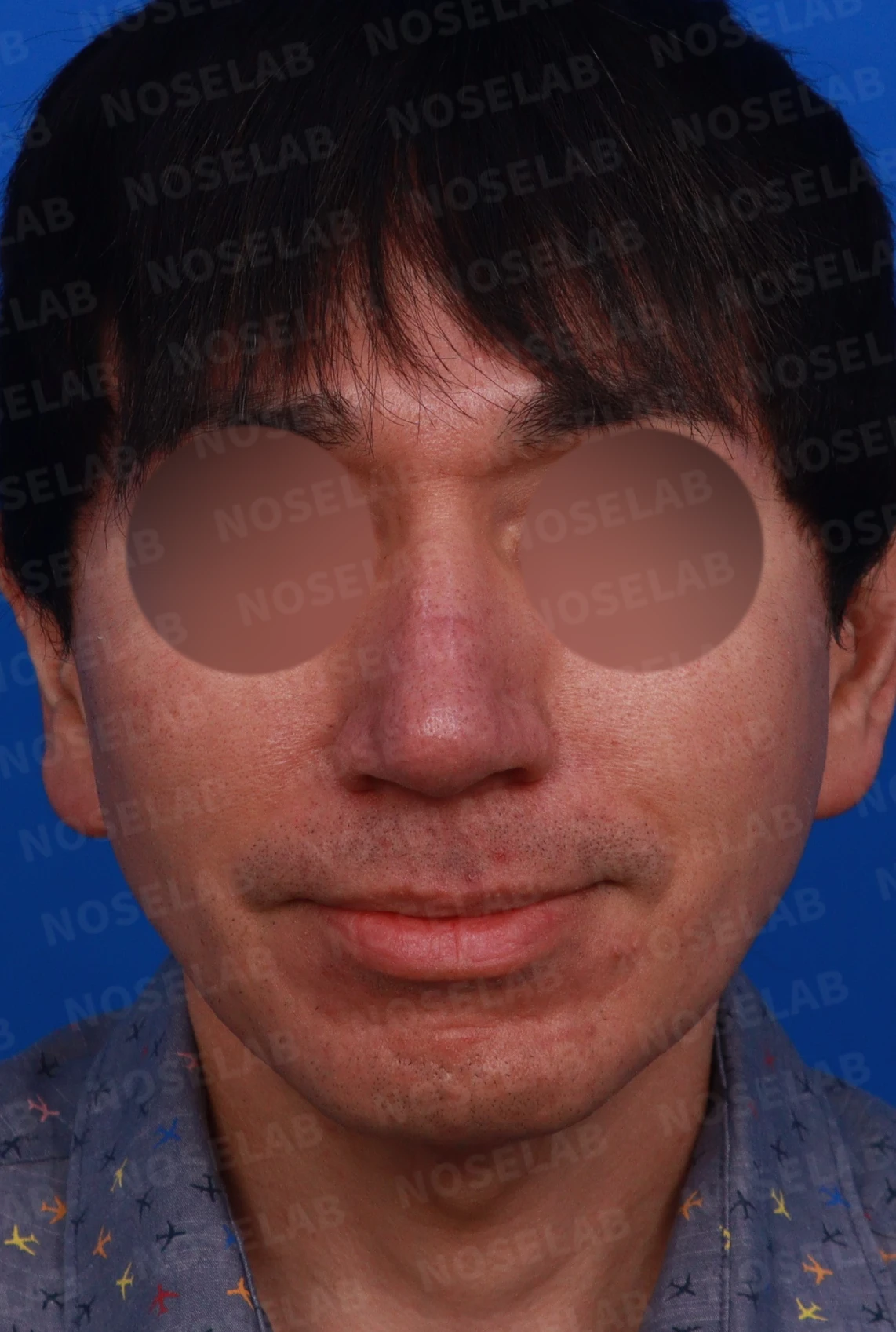 큰 코와 얼굴 비율을 함께 고려한 교정 방법 — 디자인 상담 정면, 좌측 측면, 비스듬한 측면 사진입니다.
