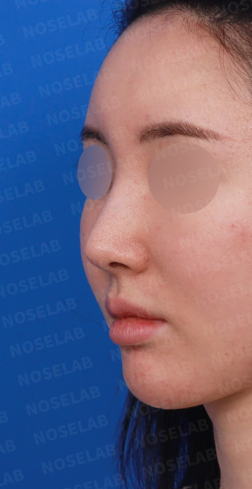 코가 길어 보이고 비주가 휘는 이유, 비중격 연장과 재건은 어떻게 하나 — 디자인 상담 정면, 좌측 측면, 비스듬한 측면 사진