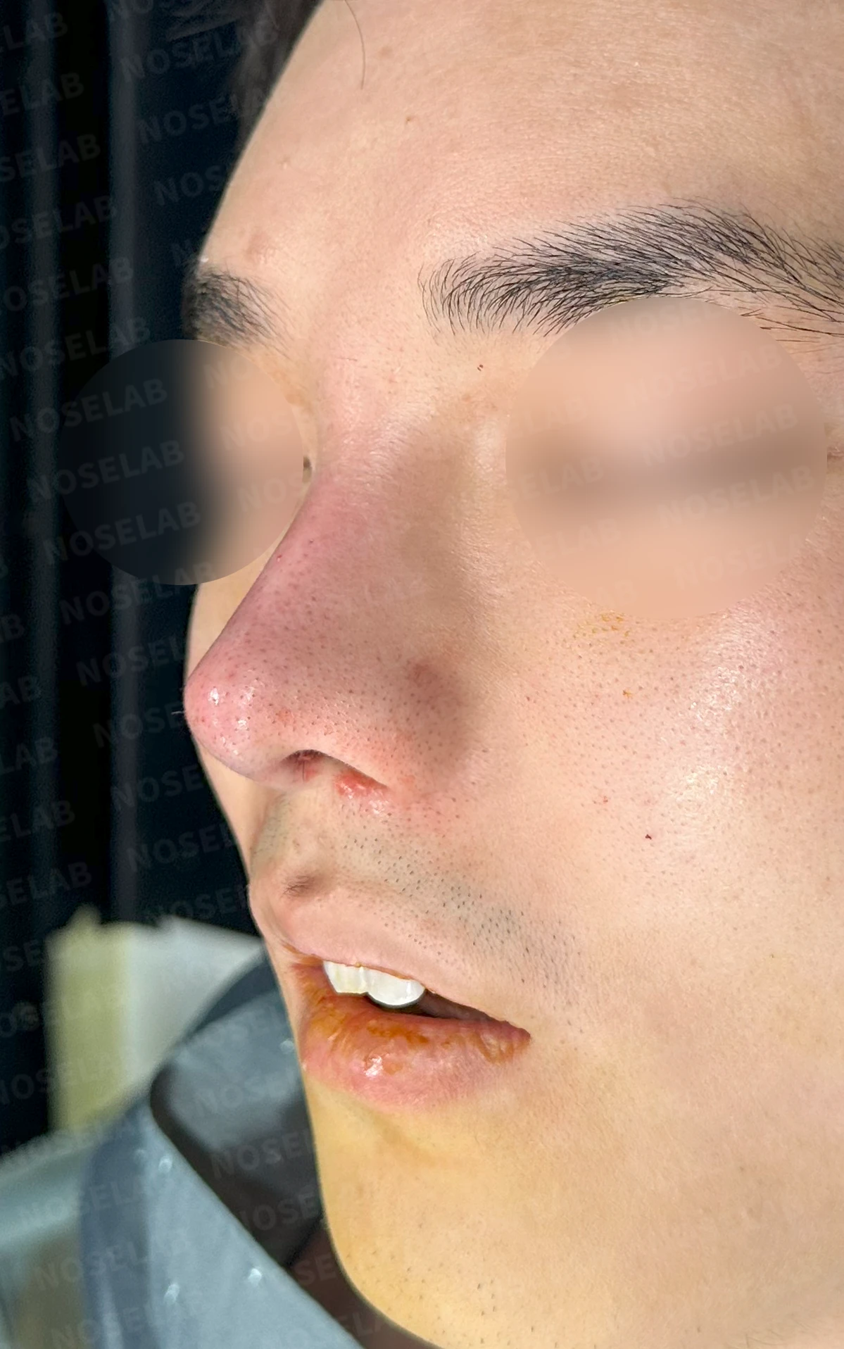 코 실 시술과 지방이식 후 라인이 잡히지 않는 이유, 제거와 늑연골 재건은 어떻게 하나 — 수술 전 / 수술 직후 0일 직후 사진은 부기가 있는 상태로 최종 결과와 다를 수 있습니다.