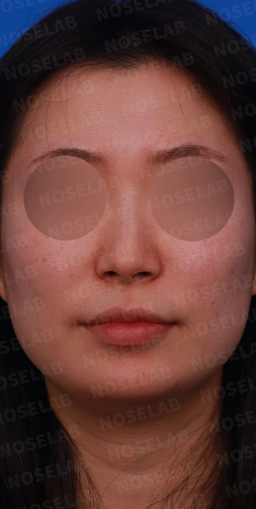 매부리코와 휜 코에 코막힘이 함께 오는 이유, 복합 교정은 어떻게 하나 — 디자인 상담 정면, 비스듬한 측면, 측면 사진입니다.