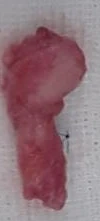 메드포어 점막 돌출로 인한 염증 코 - 자가늑연골 재건 수술 후기 — 제거된 이물질 사진 1. 메드포어 2. 좌측 점막으로 뚫고 나왔던 메드포어 3. 콧등 실리콘 보형물