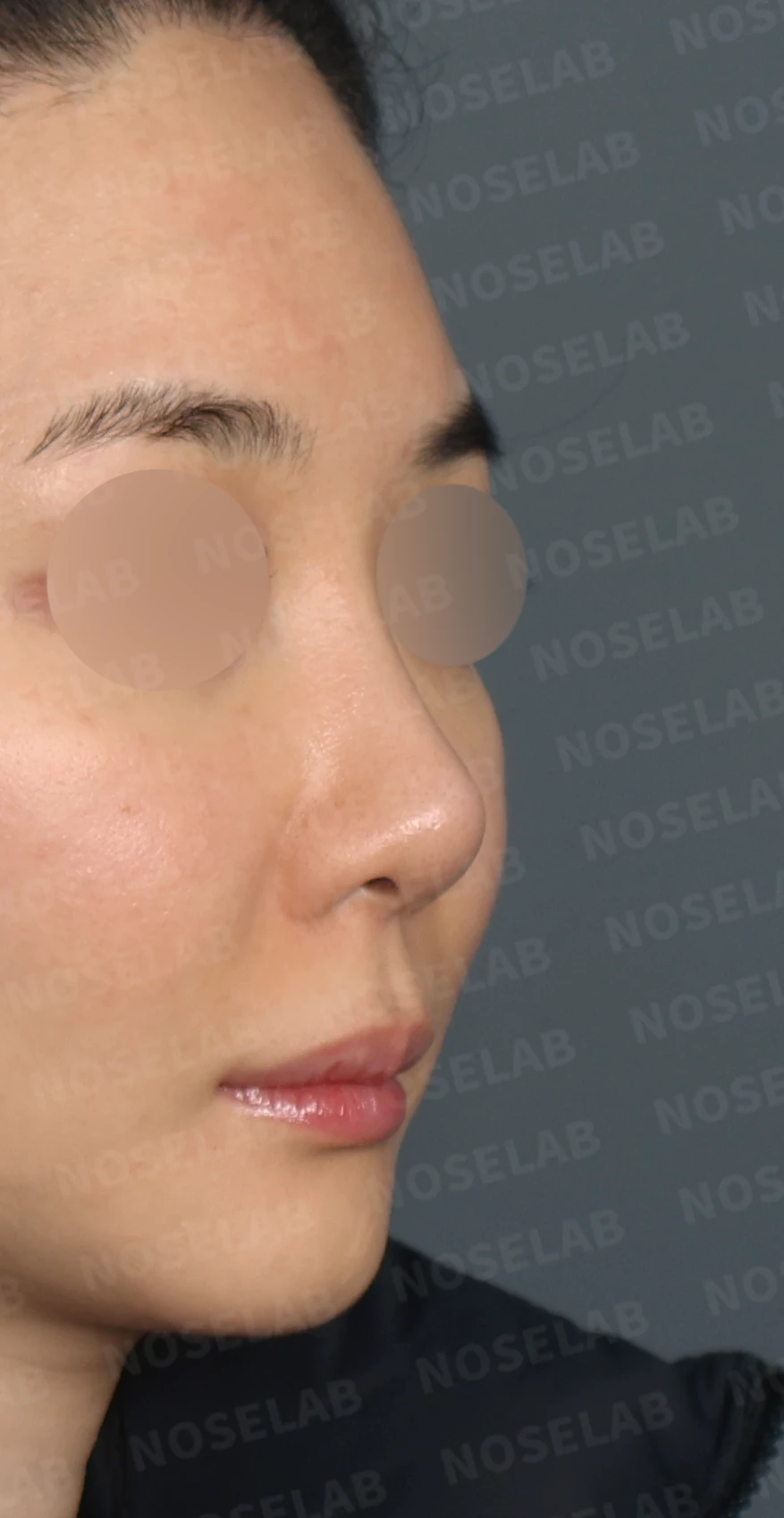L자 보형물 제거 후 자가 늑연골로 코끝을 교정한 코재수술 — 디자인 상담 우측 측면, 비스듬한 측면, 비공 사진