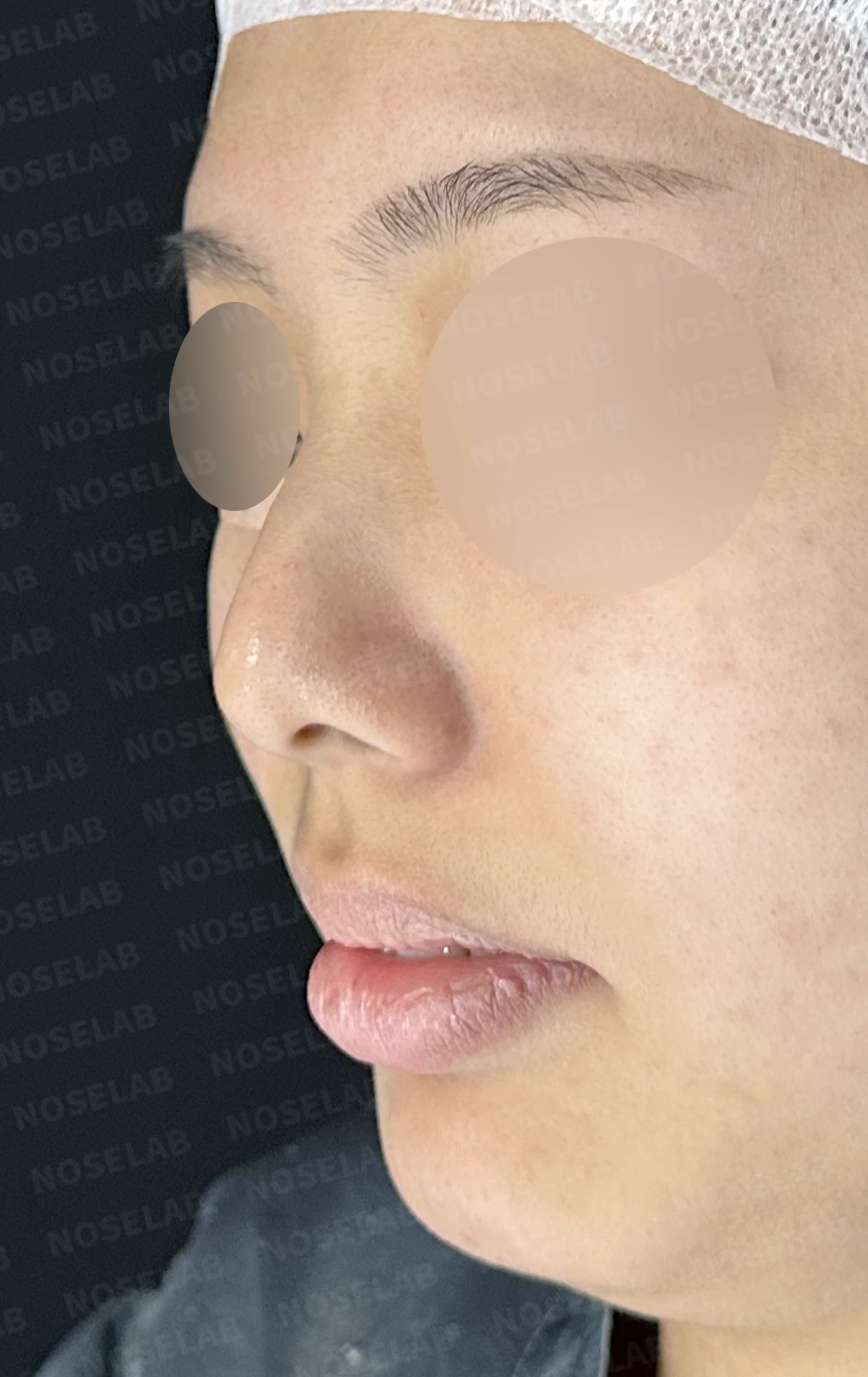 휘어진 매부리와 처진 코끝이 생기는 이유, 비중격 연장술은 어떻게 하나 — 수술 전 / 수술 직후 0일 직후 사진은 부기가 있는 상태로 최종 결과와 다를 수 있습니다.