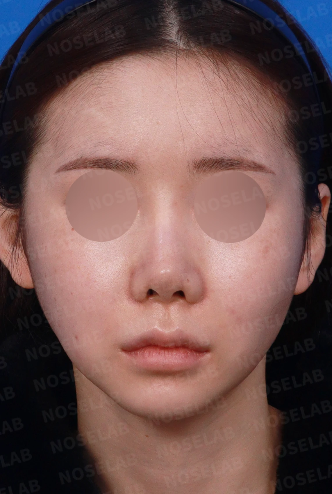 코성형 뒤 코끝이 들리고 비주가 짧아 보이는 이유, 비주 하강과 콧대 라인 교정 방법 — 디자인 상담 정면, 좌측 측면, 비스듬한 측면 사진입니다.