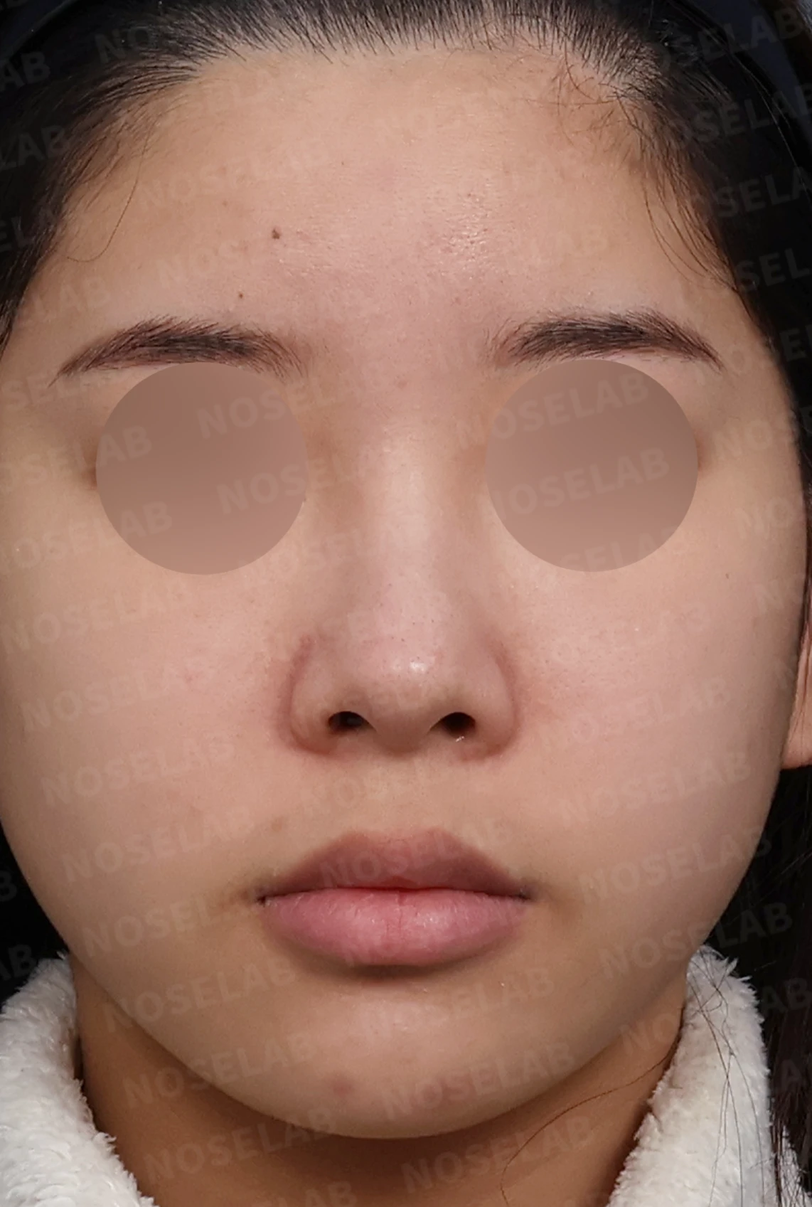 콧대가 넓고 단차져 보이는 이유, 절골술과 늑연골 코끝 성형은 어떻게 하나 — 디자인 상담 정면, 좌측 측면, 비스듬한 측면 사진입니다.
