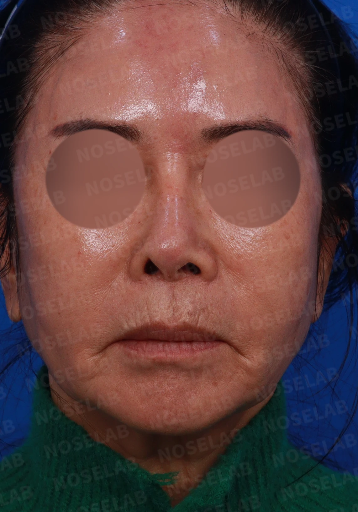 오래된 실리콘 보형물이 변형과 통증을 일으키는 이유, 늑연골 재건은 어떻게 하나 — 디자인 상담 정면, 좌측 측면, 비스듬한 측면 사진