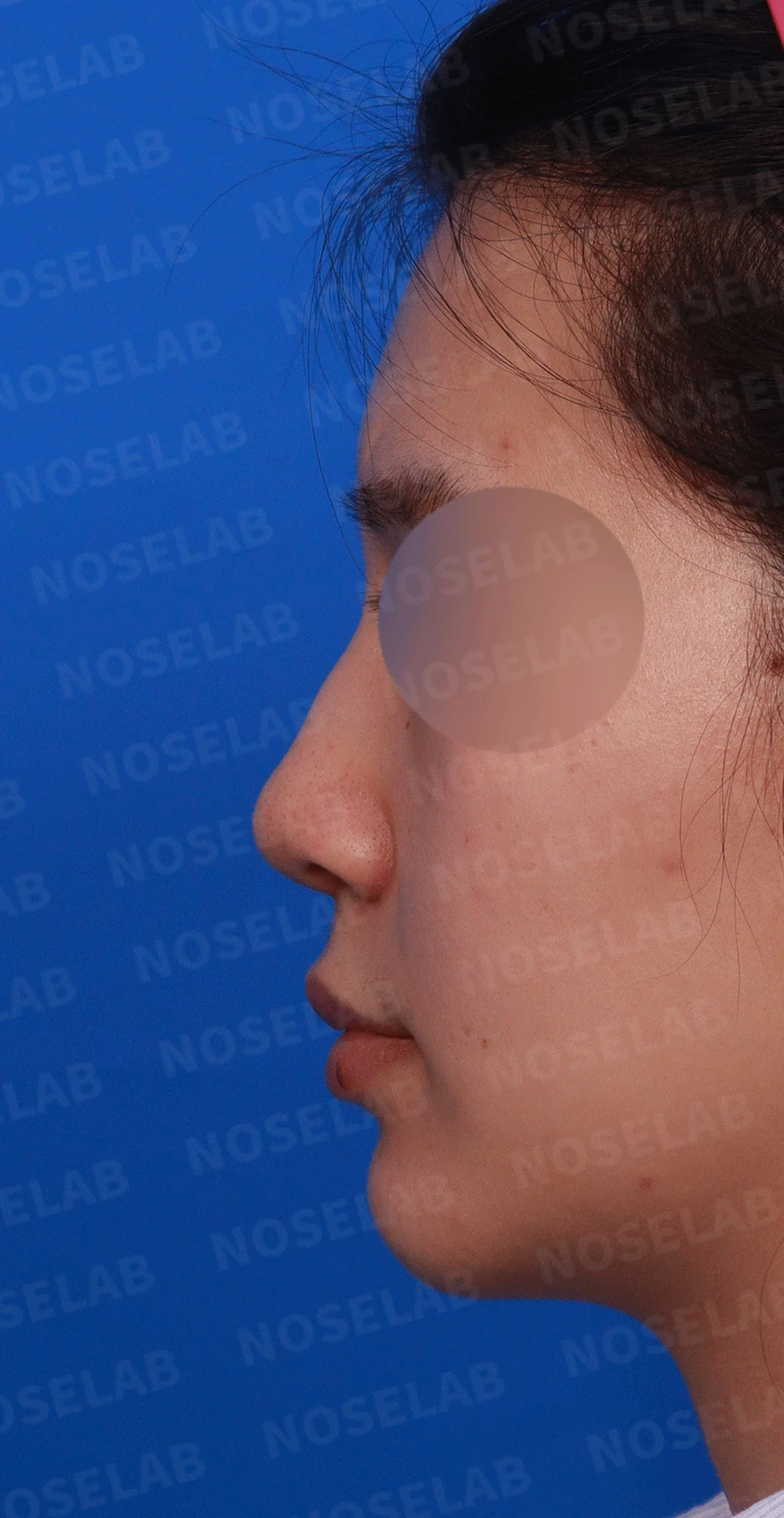 복코가 잘 교정되지 않는 이유와 이물질 제거 후 재건 방법 — 디자인 상담 정면 , 좌측 측면 ,비스듬한 측면 사진