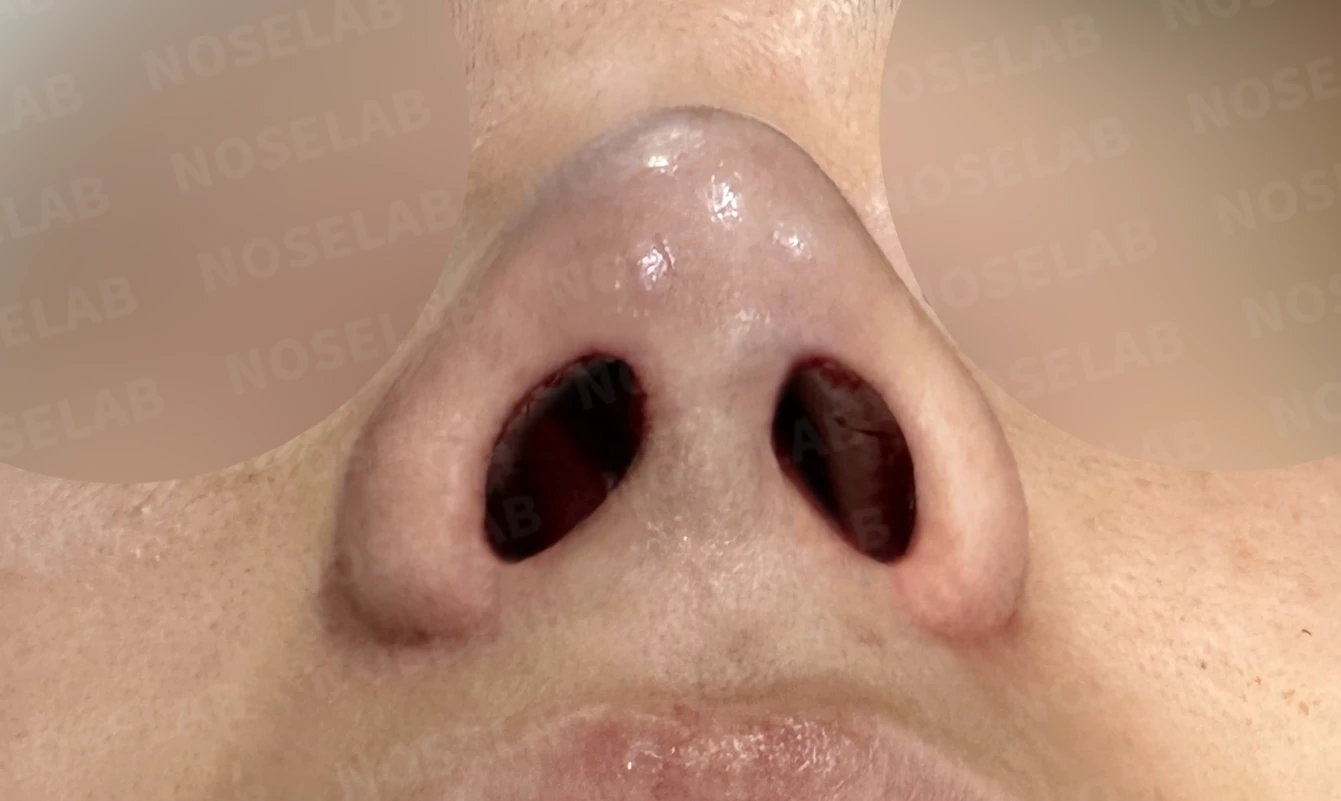 한쪽 비골이 함몰되면 왜 코가 휘어 보이는가, 절골 복원과 비중격 재건 — 수술 직후 0일 비공 사진 직후 사진은 부기가 있는 상태로 최종 결과와 다를 수 있습니다.
