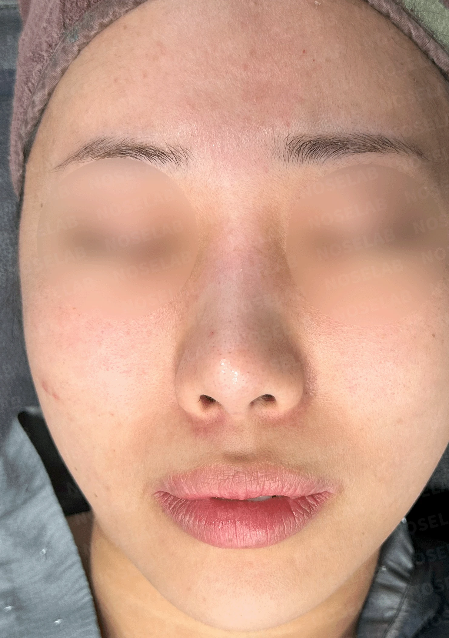 인위적인 코에서 자연스러운 아름다움으로 - 맞춤형 코 재건술 사례 — 본문 사진 7