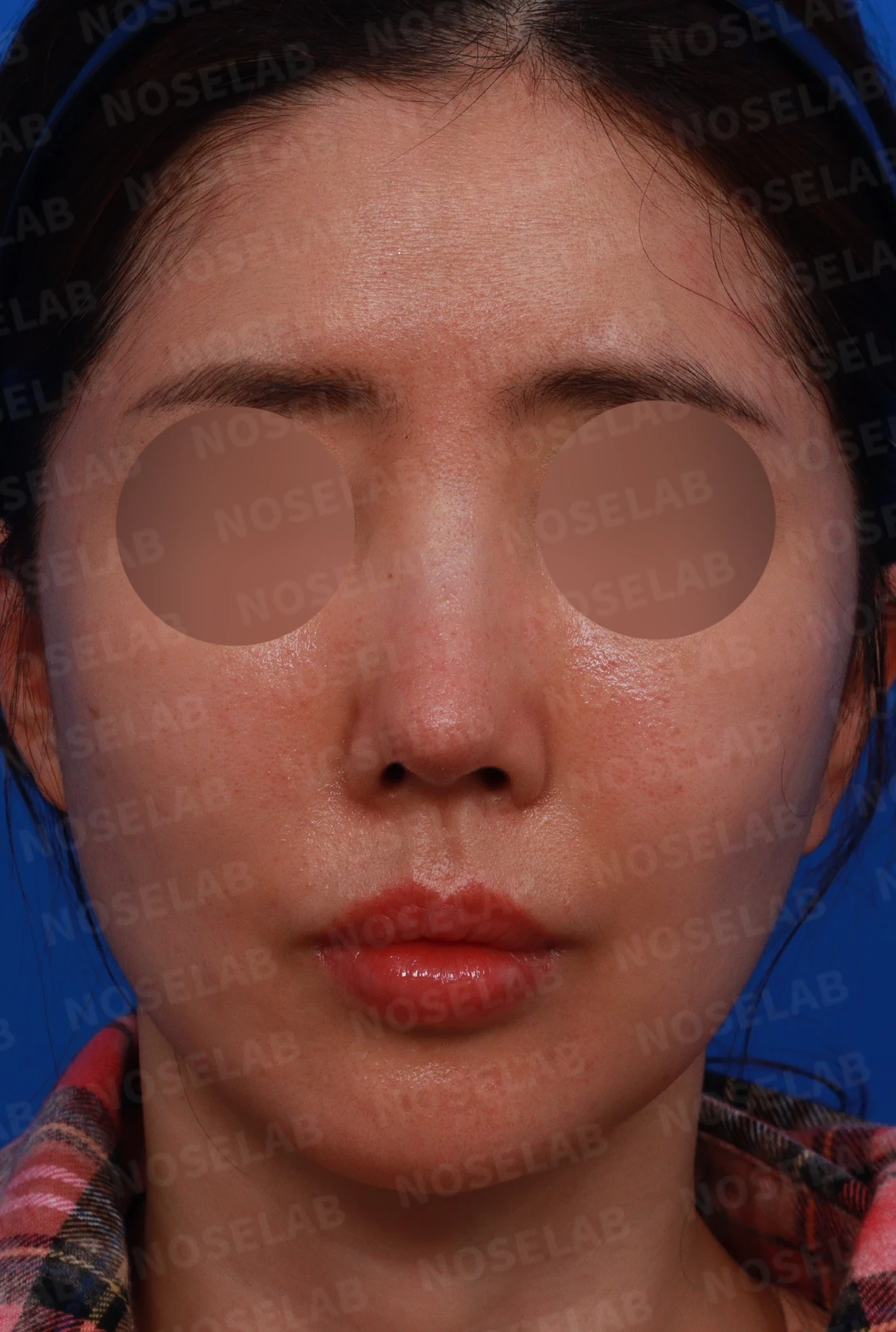 긴 코와 비대칭을 함께 교정하는 재수술 방법 — 디자인 상담 정면, 좌측 비스듬한 측면, 측면 사진