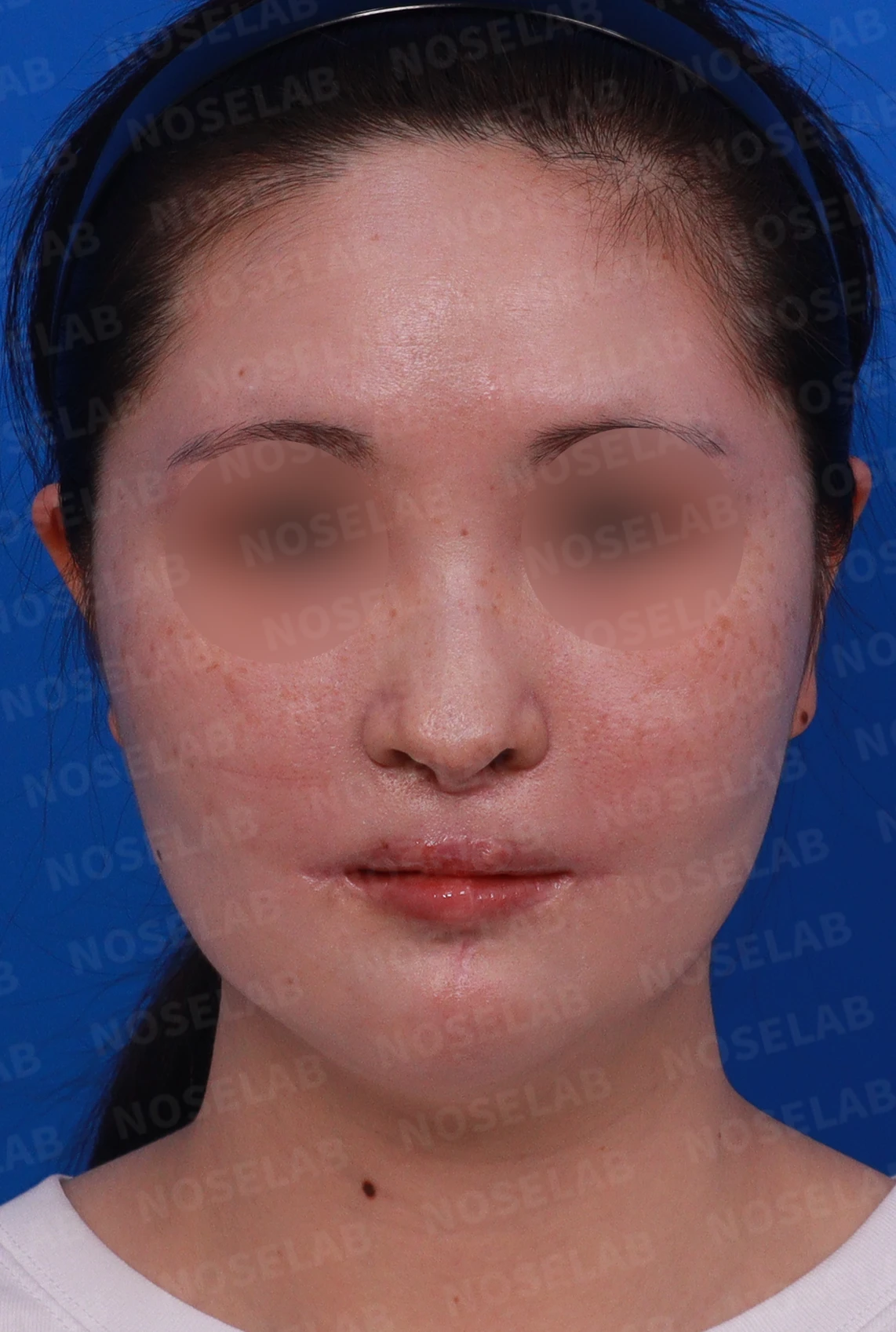 구순구개열에서 코 비대칭이 남는 이유와 늑연골·귀연골 재건 방법 — 디자인 상담 정면 , 좌측 비스듬한 측면 , 측면 사진입니다.