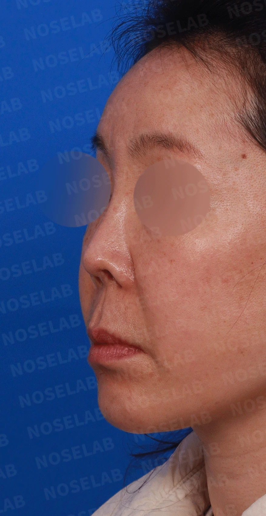 코가 짧고 들리며 비주가 함몰되는 이유, 자가 늑연골 재건은 어떻게 하나 — 디자인 상담 정면, 좌측 측면, 비스듬한 측면 사진