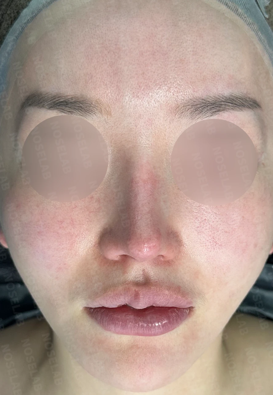 코막힘, 처진코, 비주내리기 코성형 방법 — 본문 사진 1