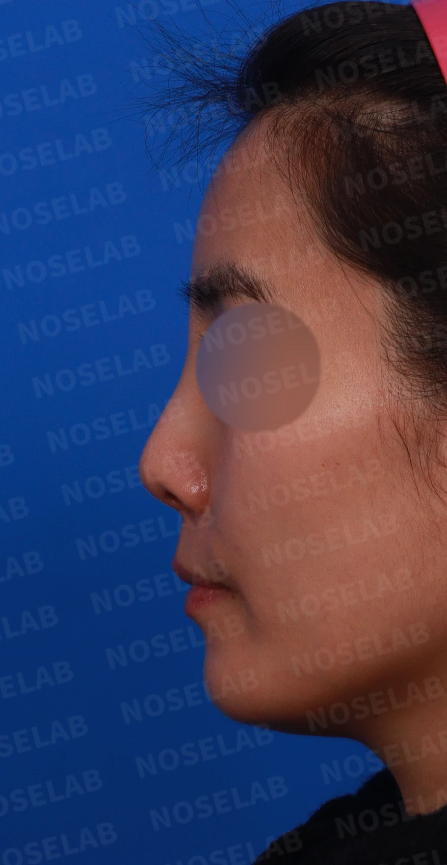 여러 차례 받은 코필러가 남긴 퍼진 코와 코막힘, 어떻게 정리하나 — 디자인 상담 정면, 좌측 측면, 비스듬한 측면 사진