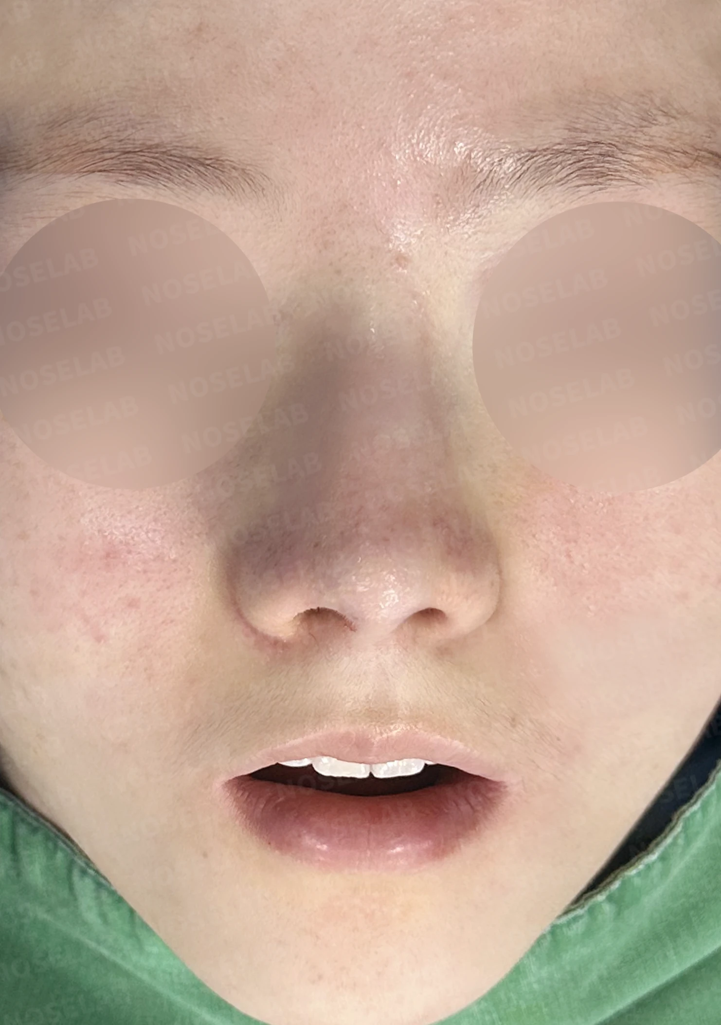 콧대가 퍼져 보이고 코끝이 뭉툭한 이유, 절골술과 자가 늑연골 교정은 어떻게 하나 — 수술 직후 0일 정면, 비스듬한 측면, 측면 사진입니다. 직후 사진은 부기가 있는 상태로 최종 결과와 다를 수 있습니다.