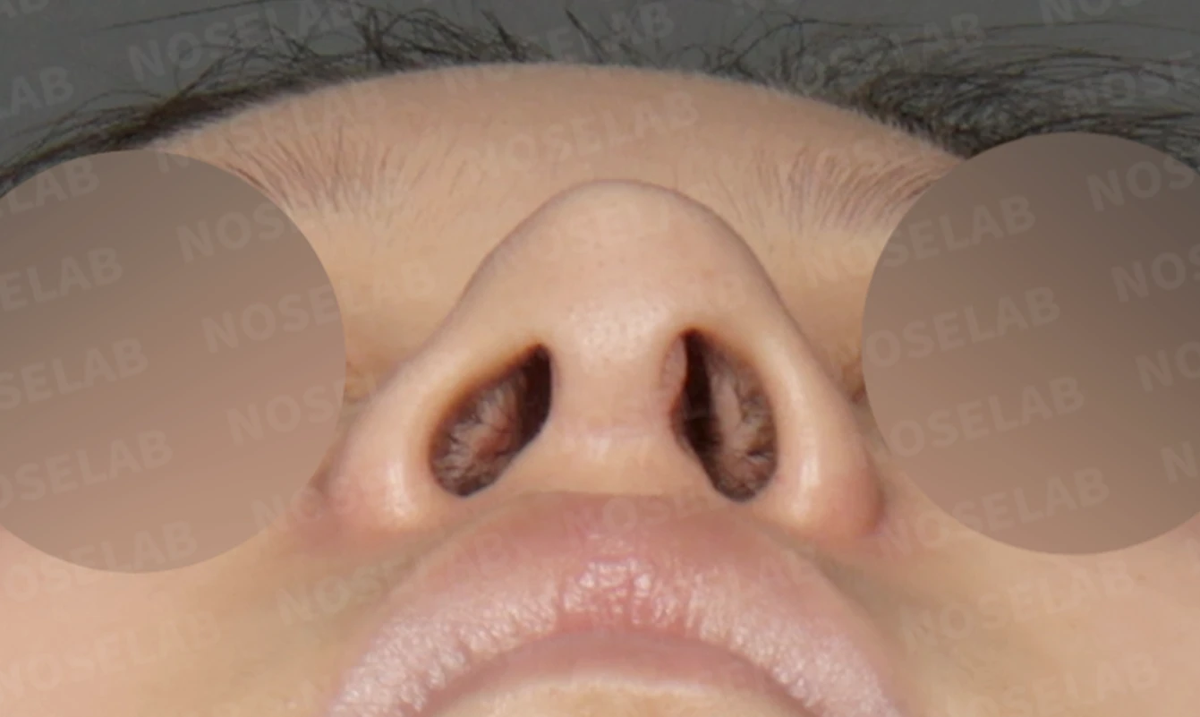 휘어진 코와 복코, 자가늑연골 비중격 재건으로 안전하게 교정한 코재수술 — 전(좌) , 직후(우)