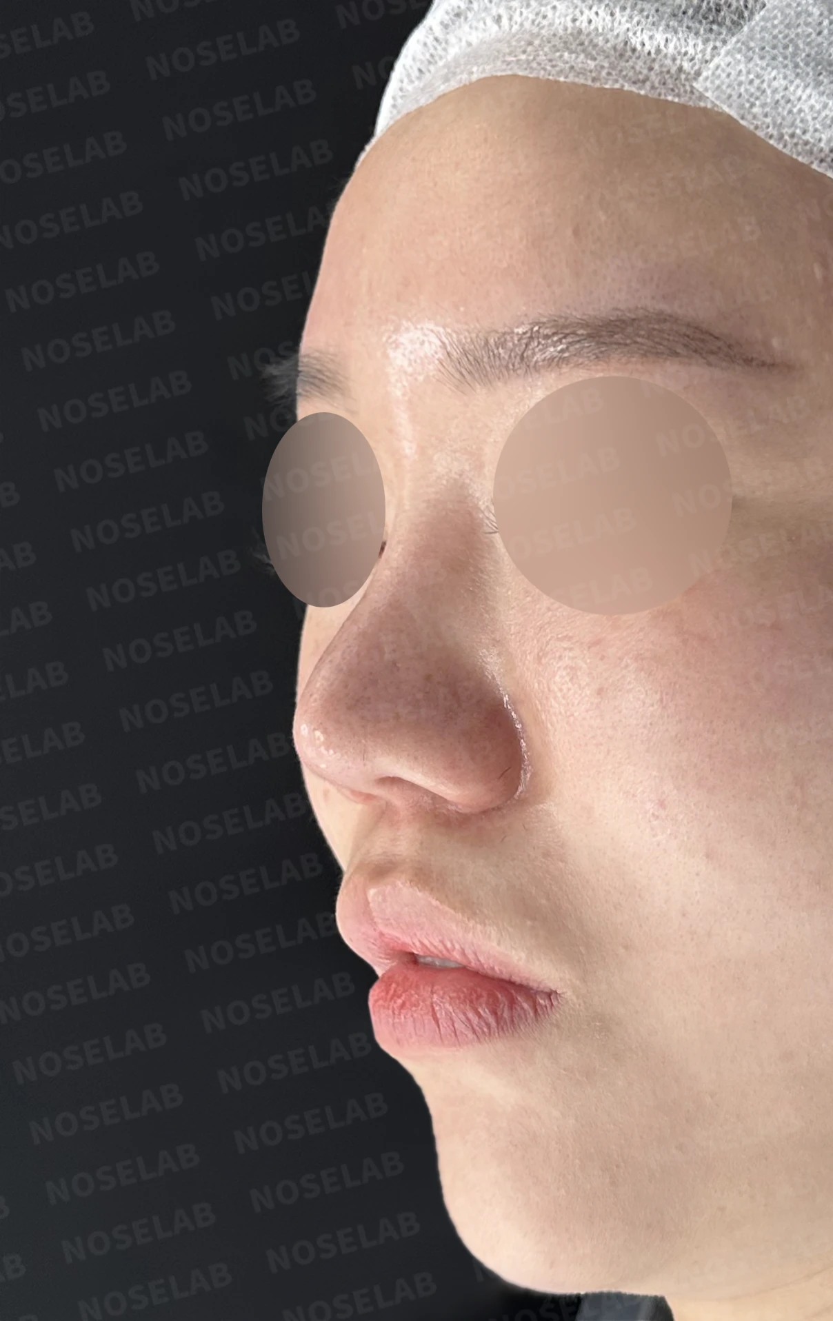 비주 함몰과 콧날개 변형, 자가늑연골을 이용한 코재수술로 자연스럽게 교정 — 전(좌) 직후(후)