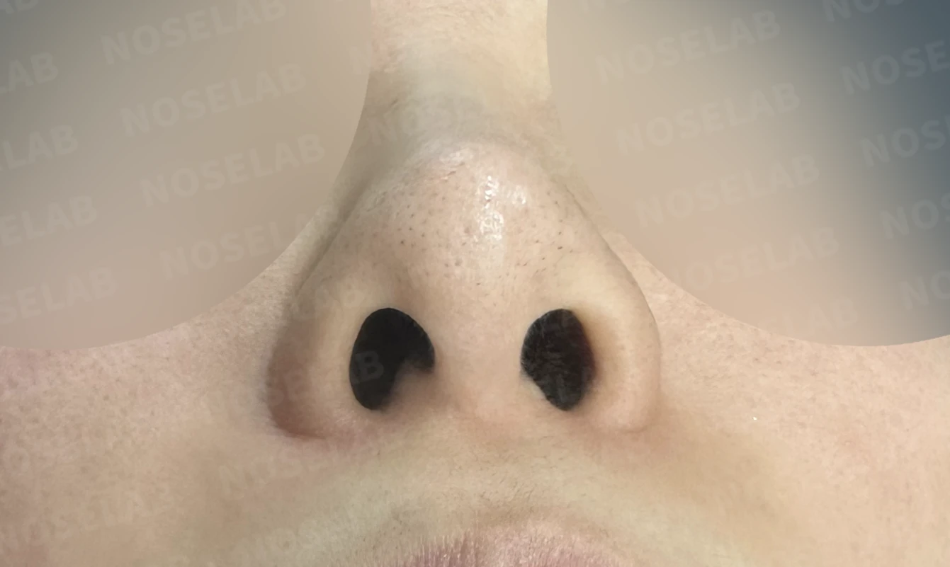 L자 보형물 제거 후 자가 늑연골로 코끝을 교정한 코재수술 — 전(좌) 직후(후)