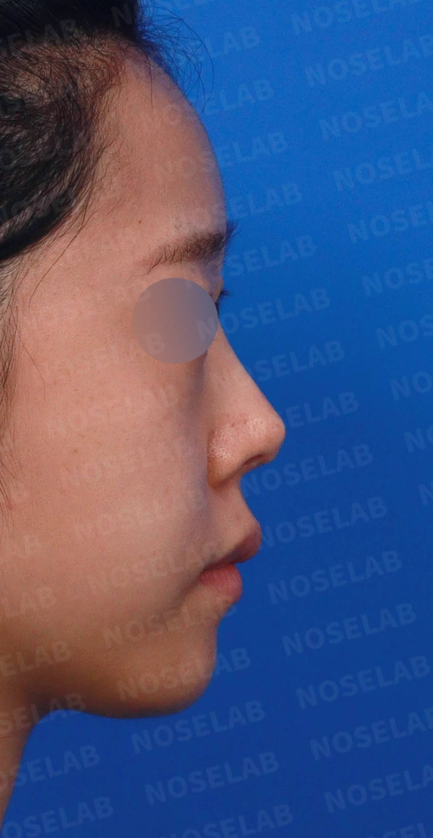 코끝 피부가 얇아져 연골이 비치는 이유, 피부 보강은 어떻게 하나 — 디자인 상담 우측 측면, 비스듬한 측면, 비공 사진입니다.
