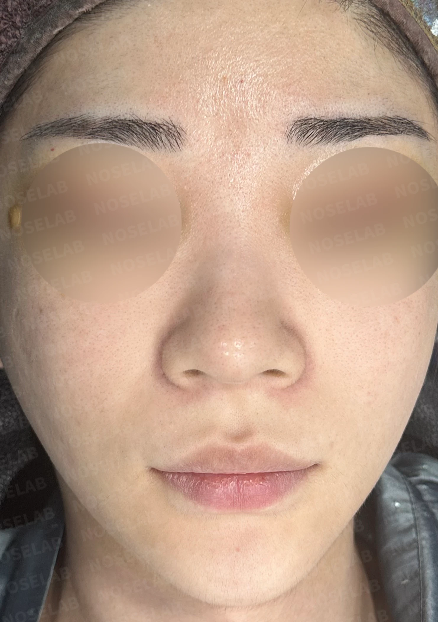 코가 뭉툭하고 퍼져 보이는 이유, 비순각과 비주는 어떻게 교정하나 — 수술 전 / 수술 직후 0일 직후 사진은 부기가 있는 상태로 최종 결과와 다를 수 있습니다.