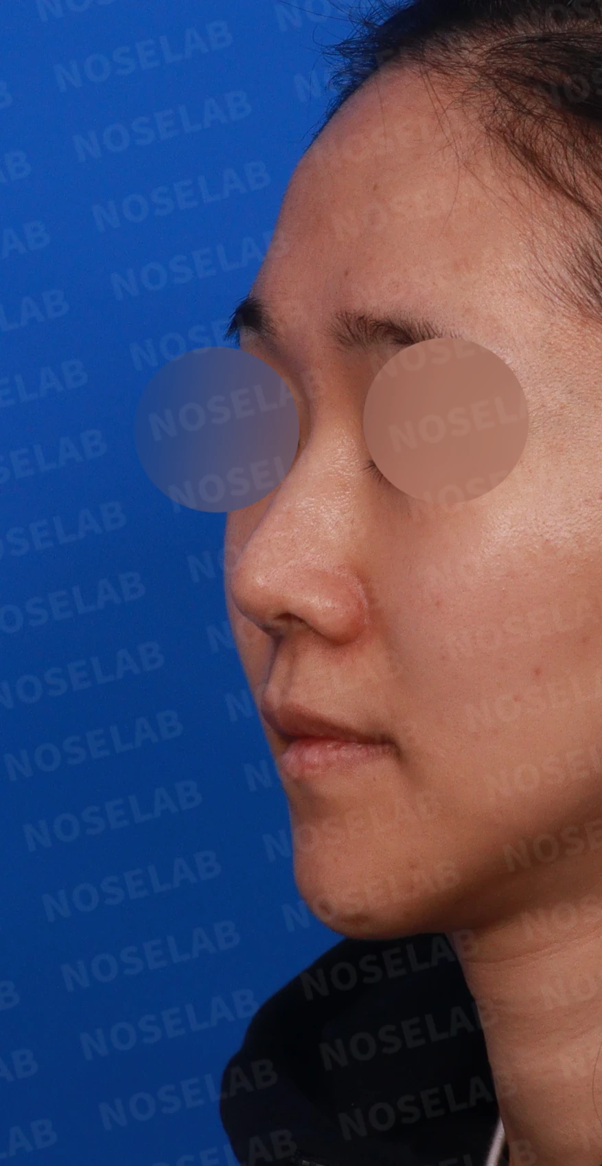 비중격 연골이 약해진 코, 보형물 없이 재건하는 방법 — 디자인 상담 정면, 좌측 측면, 비스듬한 측면 사진