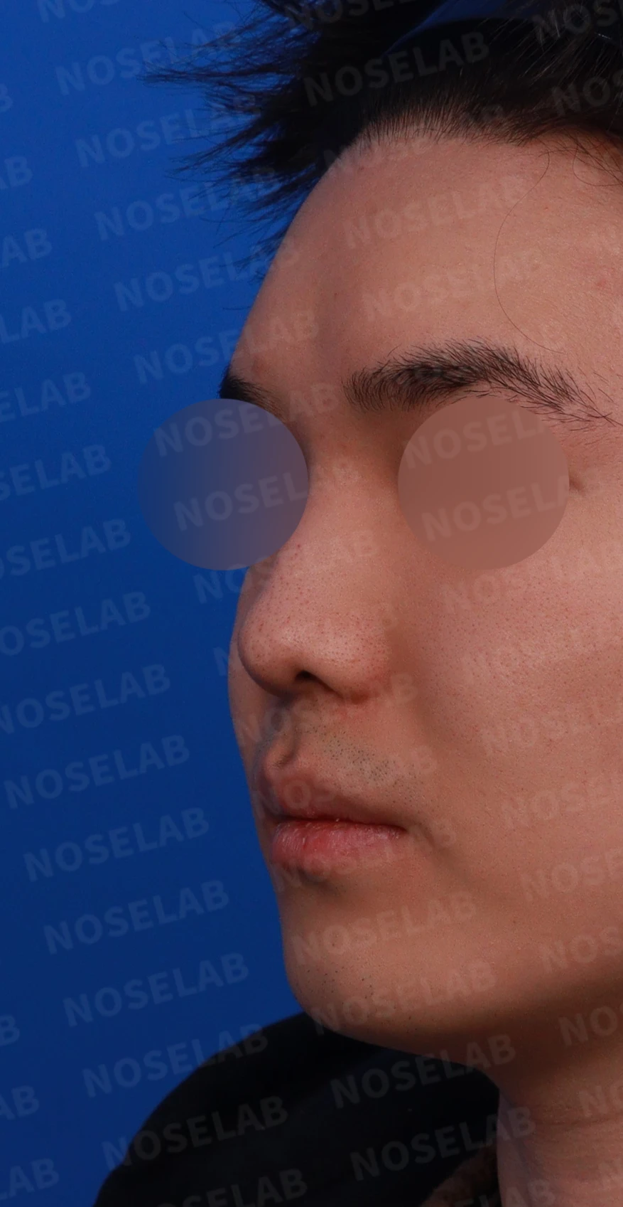 코 실 시술과 지방이식 후 라인이 잡히지 않는 이유, 제거와 늑연골 재건은 어떻게 하나 — 디자인 상담 정면, 좌측 비스듬한 측면, 측면 사진입니다.