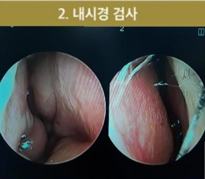 코 필러 뒤에도 휜 코와 코막힘이 남는 이유, 교정은 어떻게 하나 — 비내시경사진 1. 우측 2. 좌측