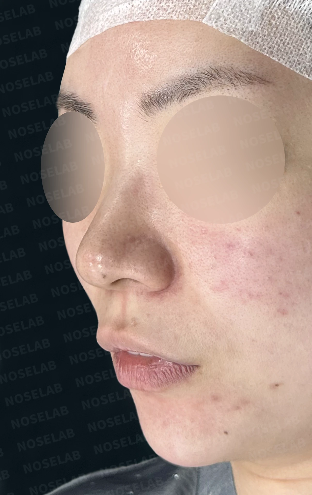 코끝이 퍼져 보이는 이유와 코바닥·비순각을 함께 다루는 방법 — 수술 전 / 수술 직후 0일 직후 사진은 부기가 있는 상태로 최종 결과와 다를 수 있습니다.