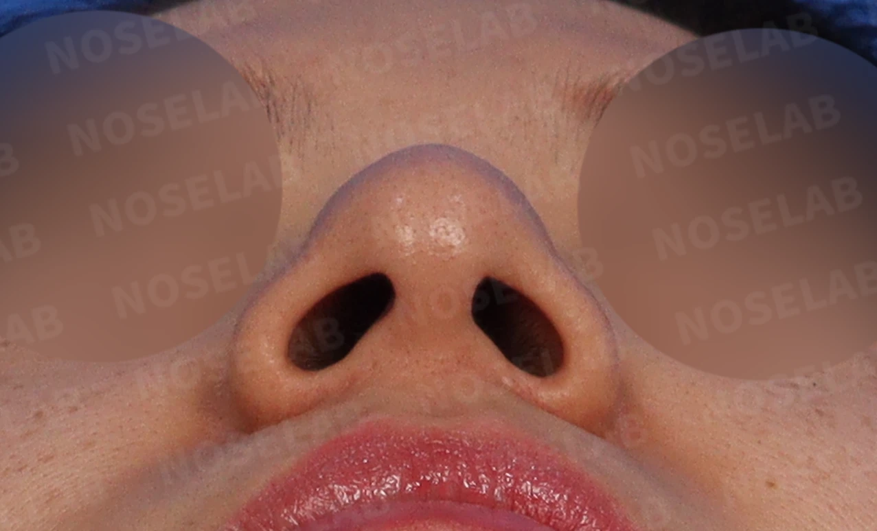 복코, 퍼진코 교정 방법 — 콧구멍 사진입니다.
