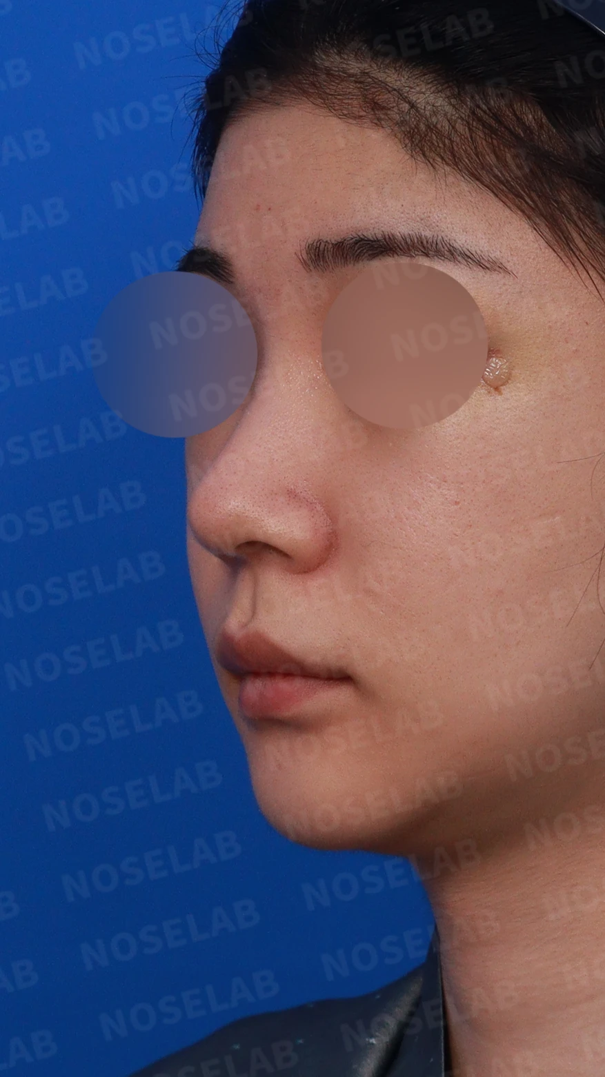 코가 뭉툭하고 퍼져 보이는 이유, 비순각과 비주는 어떻게 교정하나 — 디자인 상담 정면, 좌측 측면, 비스듬한 측면 사진