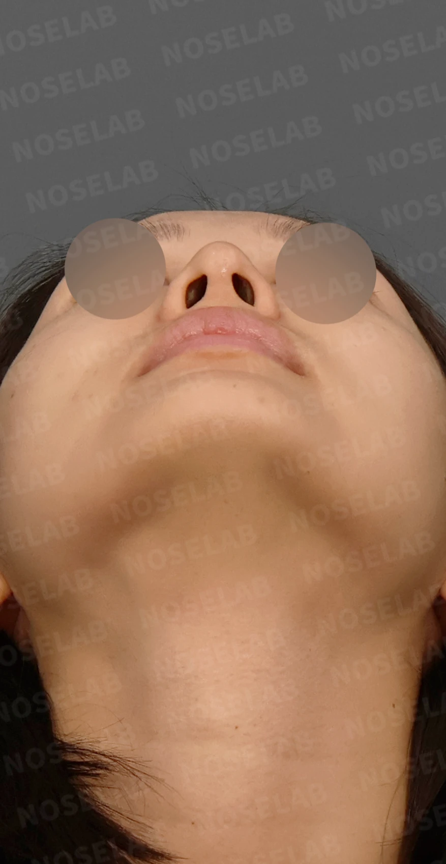 코성형 뒤 코끝이 처져 코가 길어 보이는 이유, 자가늑연골 코끝 재건 방법 — 디자인 상담 우측 측면, 비스듬한 측면, 비공 사진입니다.