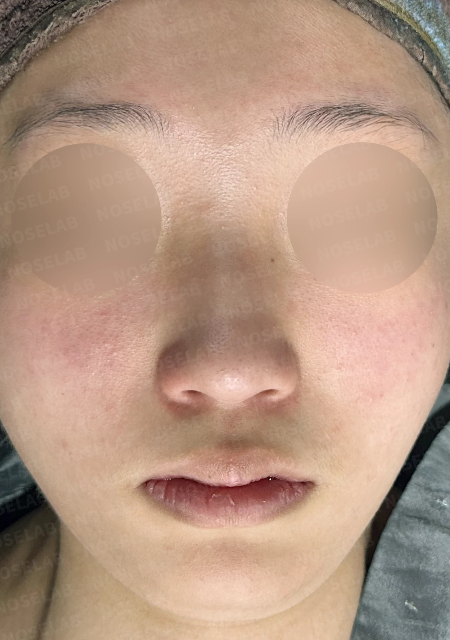작은 콧날개 연골과 처진 코끝, 자가늑연골과 외측절골술로 자연스럽게 교정 — 전(좌) 직후(후)