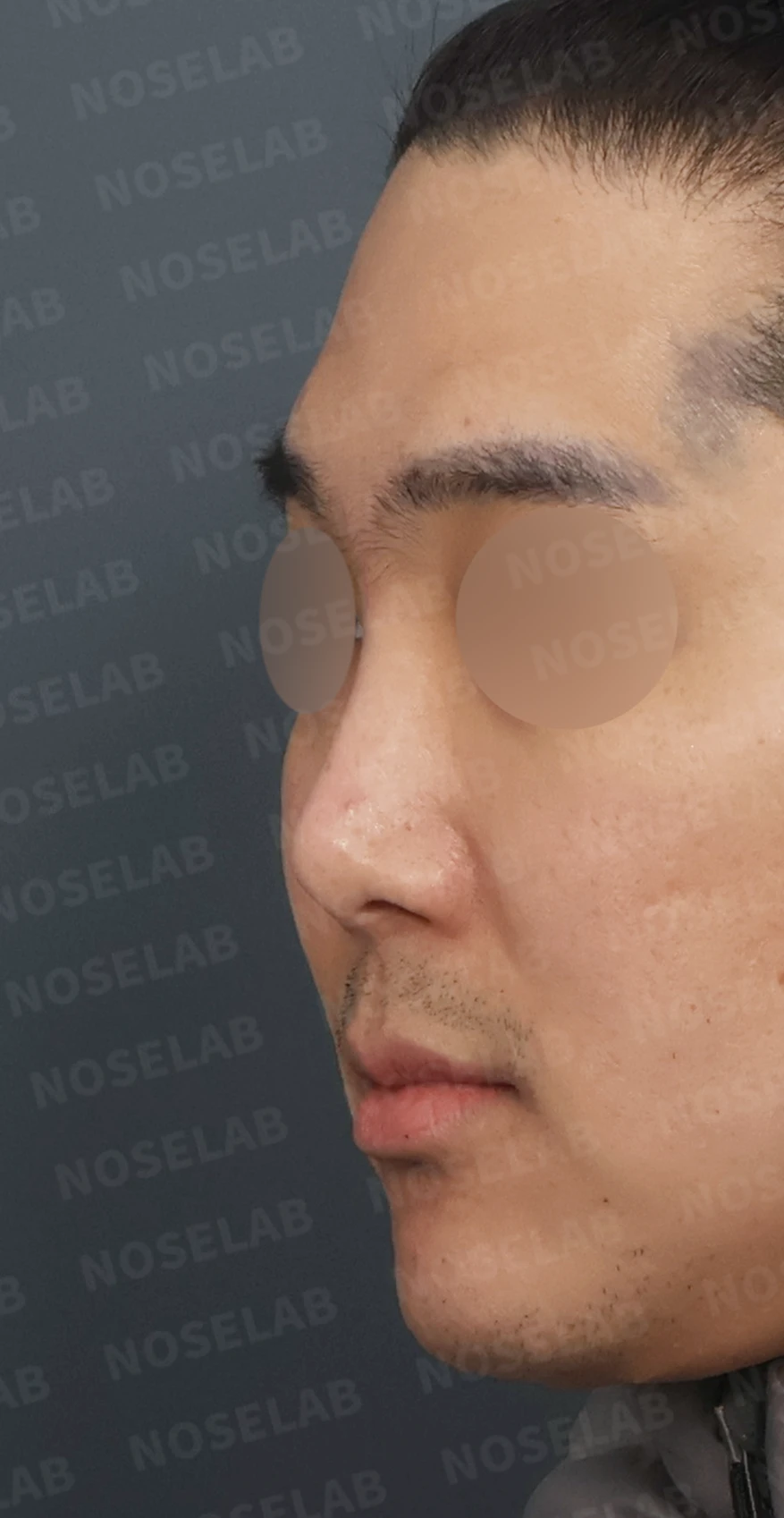 휜코 교정과 비공 비대칭, 자가늑연골로 바로잡은 코재수술 — 디자인 상담 정면, 좌측 측면, 비스듬한 측면 사진입니다.