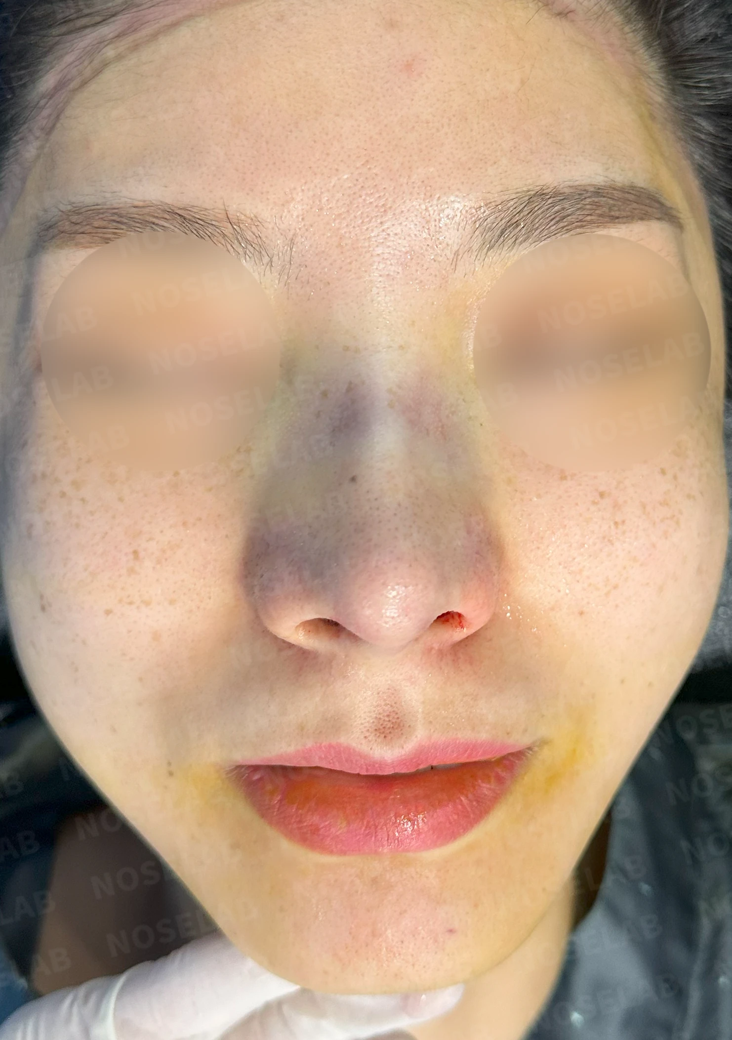 복코, 퍼진코 교정 방법 — 수술 전 / 수술 직후 0일 직후 사진은 부기가 있는 상태로 최종 결과와 다를 수 있습니다.
