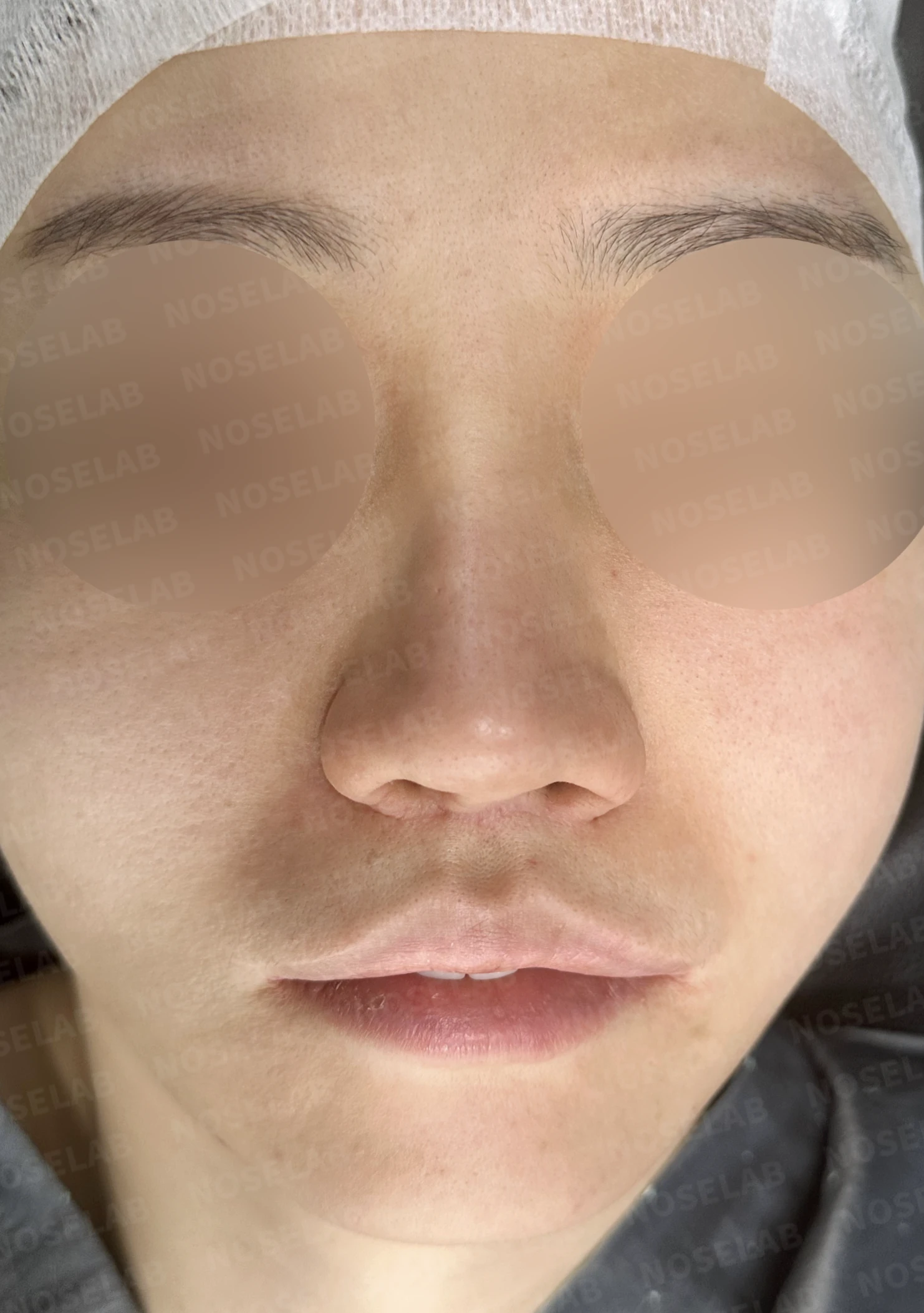 콧구멍 좌우가 심하게 달라 보이는 이유, 연골 재건과 피부이식 교정은 어떻게 하나 — 수술 전 / 수술 직후 0일 직후 사진은 부기가 있는 상태로 최종 결과와 다를 수 있습니다.