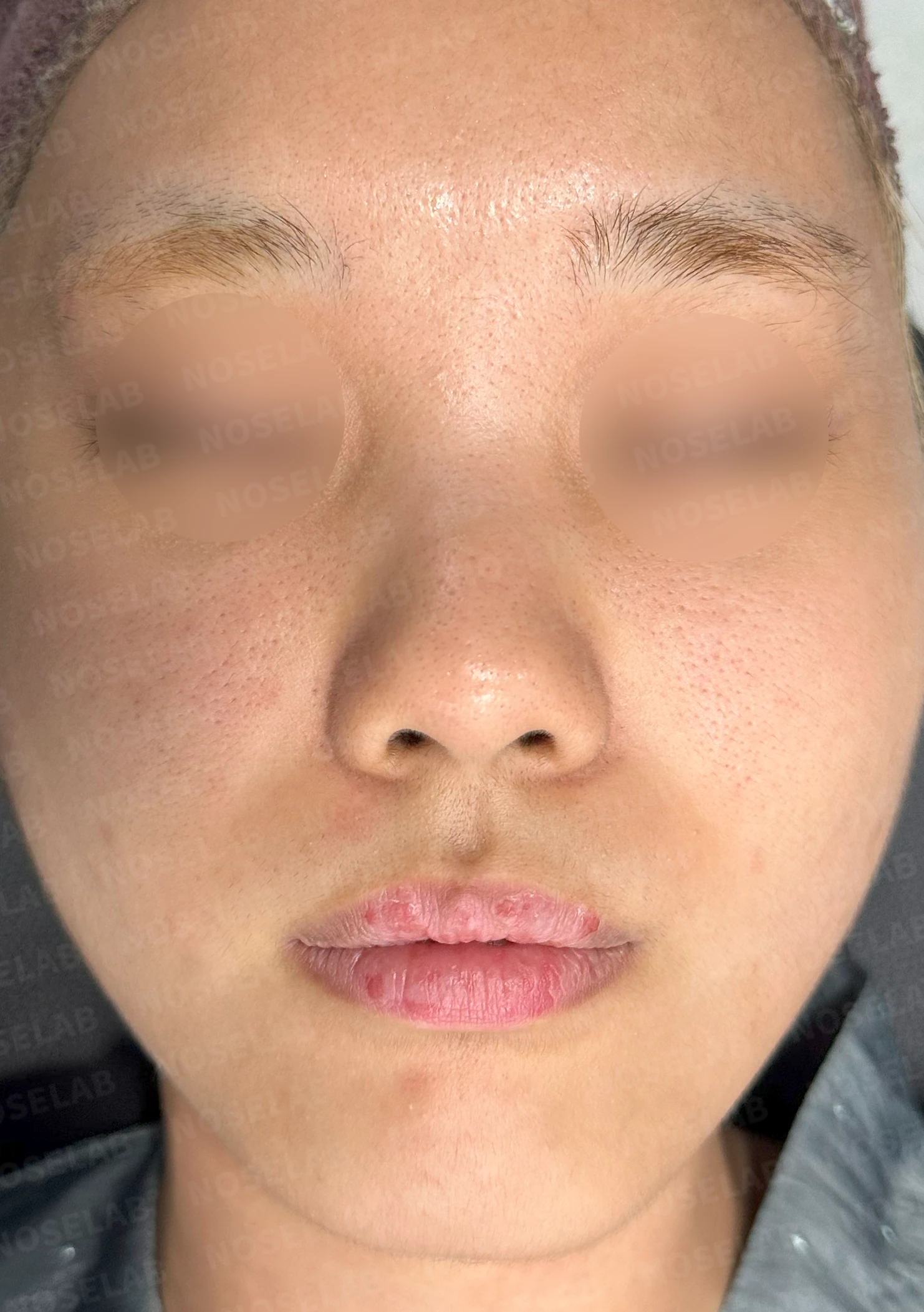 작고 뭉툭한 코는 어디까지 높일 수 있나 — 피부의 한계와 재건 방법 — 수술 전 / 수술 직후 0일 직후 사진은 부기가 있는 상태로 최종 결과와 다를 수 있습니다.