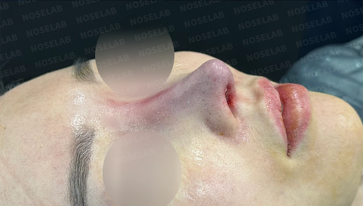 긴코 교정은 어떻게 할까요? — 수술 전 / 수술 직후 0일 직후 사진은 부기가 있는 상태로 최종 결과와 다를 수 있습니다.