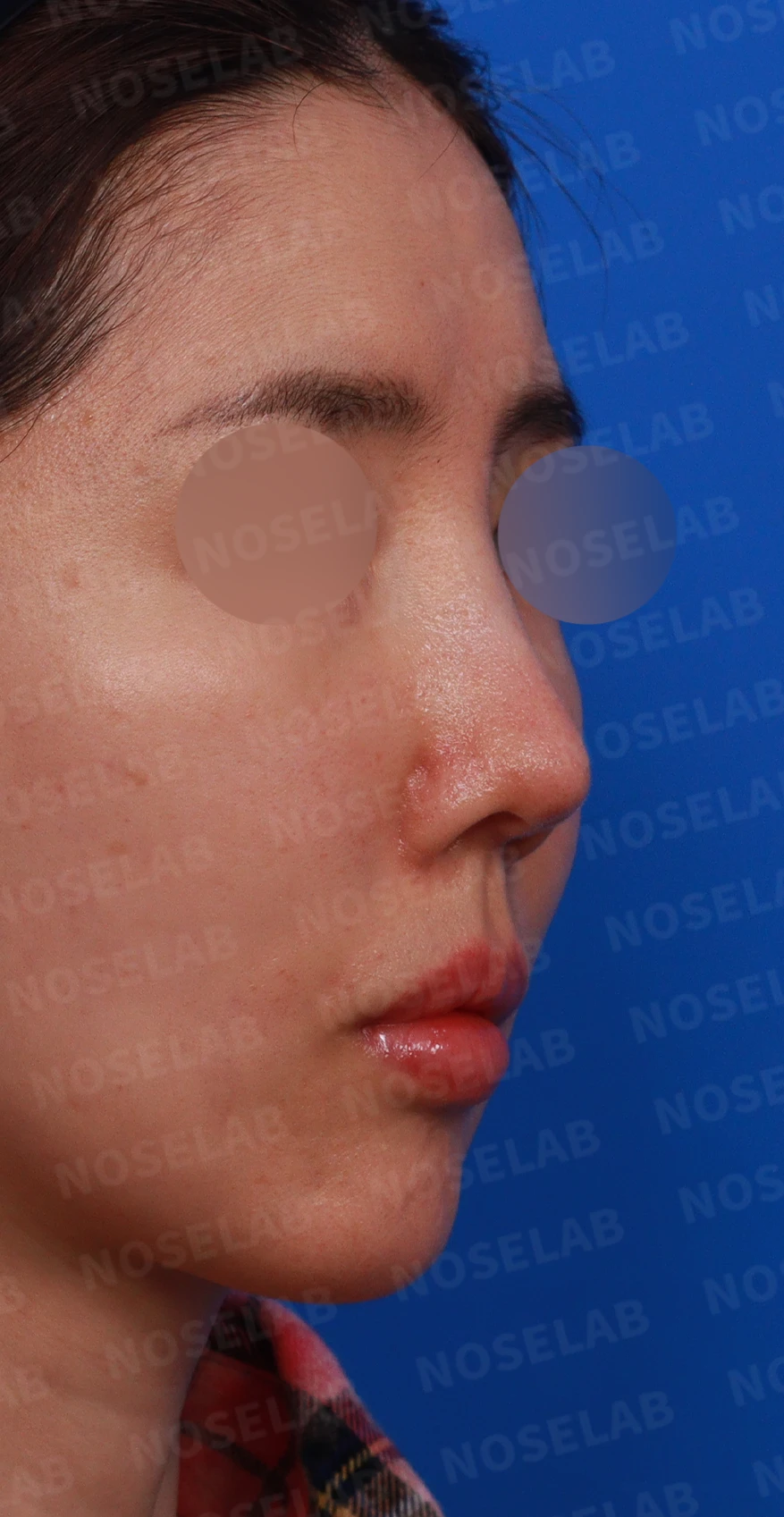 긴 코와 비대칭을 함께 교정하는 재수술 방법 — 디자인 상담 우측 측면, 비스듬한 측면, 비공 사진