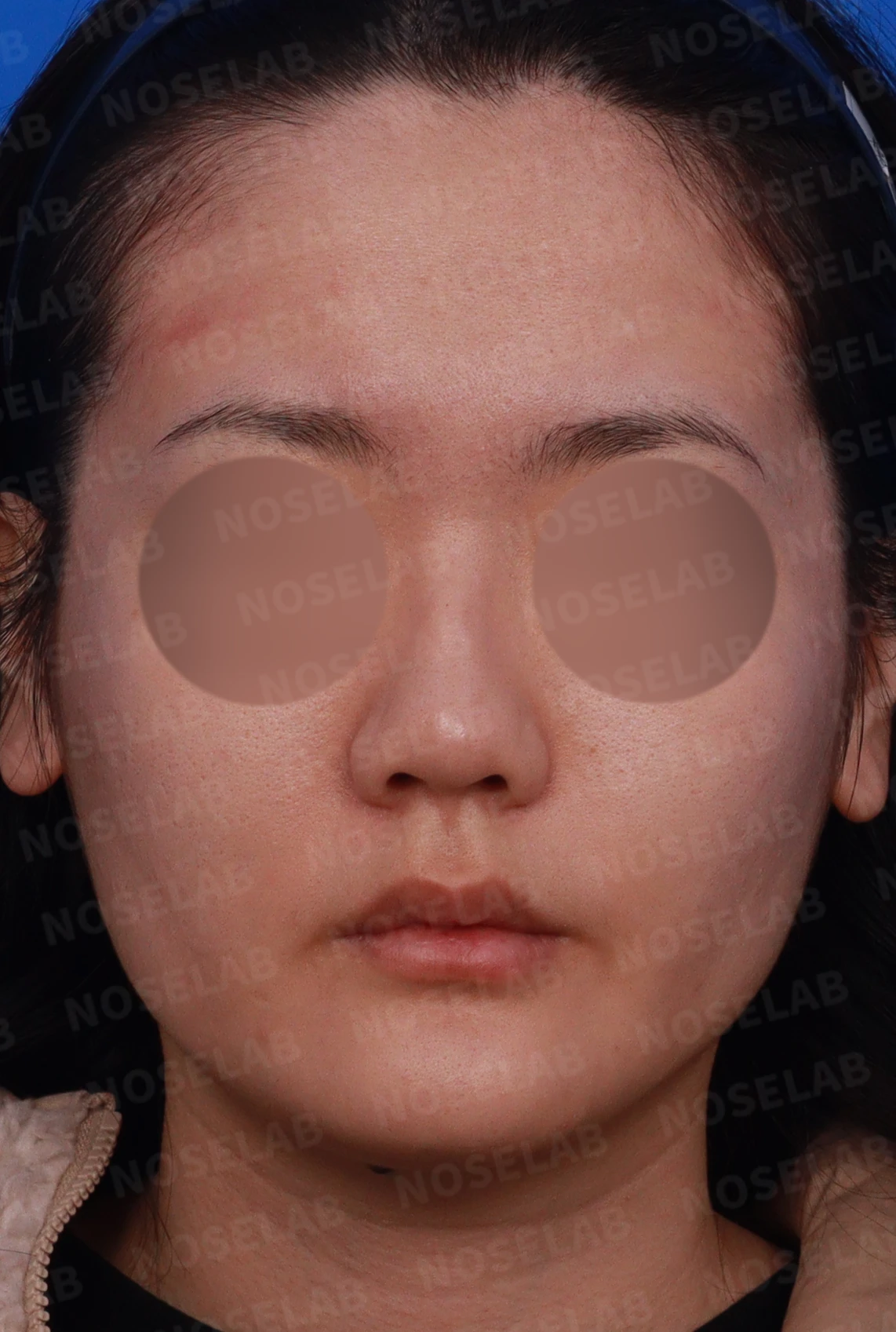 양악수술 뒤 코가 휘고 코끝이 뭉툭해지는 이유, 자가 늑연골로 매부리 라인을 만드는 방법 — 디자인 상담 정면, 좌측 측면, 비스듬한 측면 사진