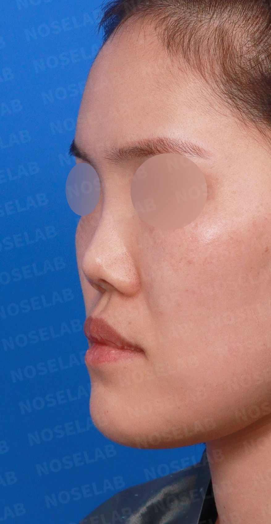 짧고 들린 코와 휜 코가 함께 생기는 이유, 비중격 연장 교정은 어떻게 하나 — 디자인 상담 정면, 좌측 측면, 비스듬한 측면 사진입니다.