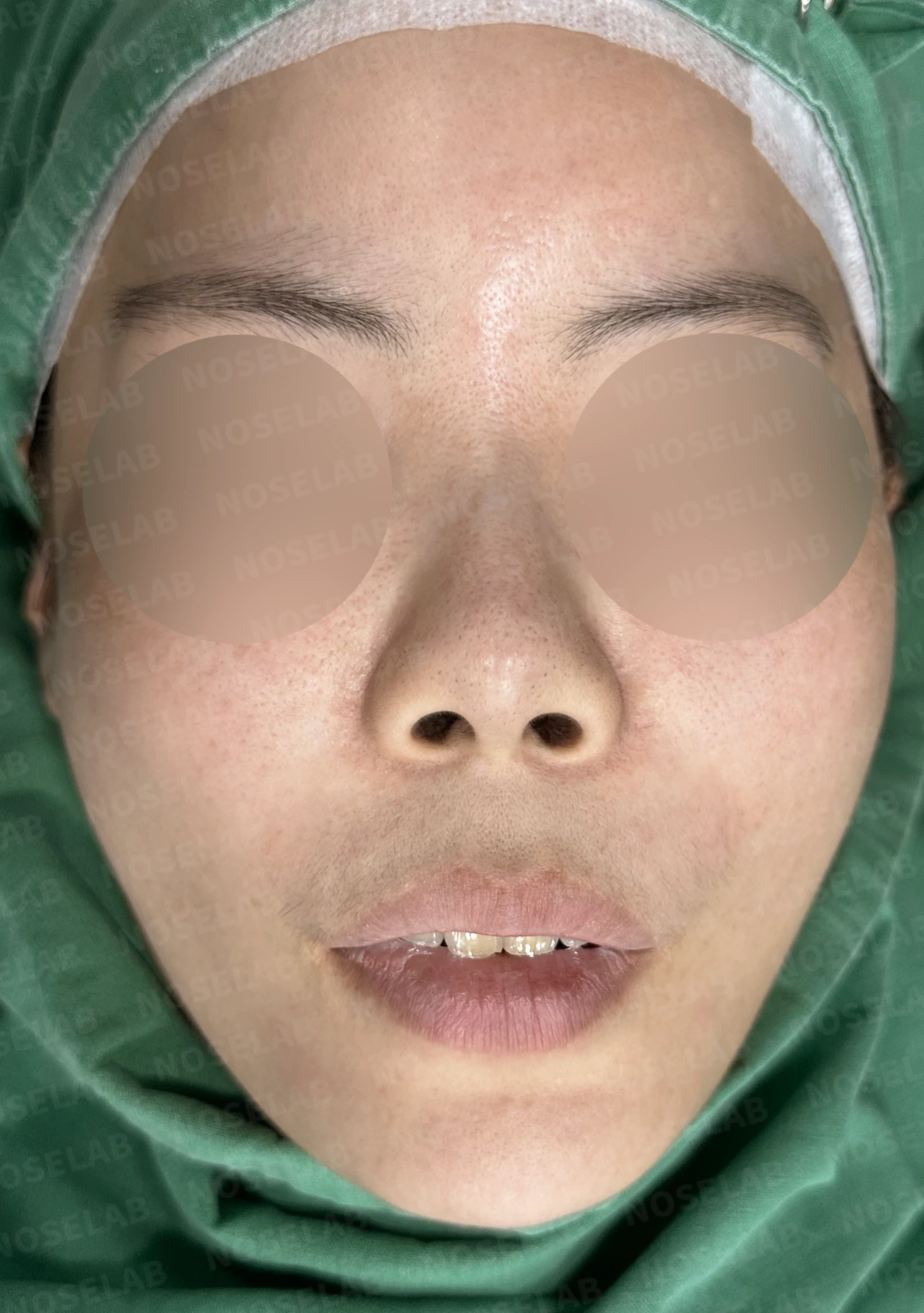 L자 실리콘 보형물이 비주 점막을 뚫기 직전까지 가는 이유, 제거와 자가늑연골 재건 방법 — 수술 전 / 수술 직후 0일 직후 사진은 부기가 있는 상태로 최종 결과와 다를 수 있습니다.